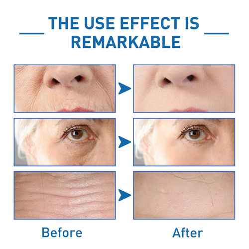 Comparison of skin with visible fine lines and wrinkles before and after using anti-aging skincare, demonstrating remarkable effects