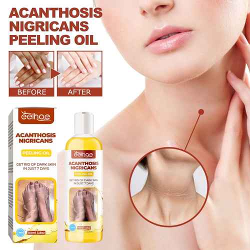 Advertisement for Acanthosis Nigricans Peeling Oil with product packaging and before/after effects on skin.