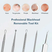 Blackhead remover lumps Popper tool kit with diagonal tweezers