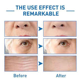 Comparison of skin with visible fine lines and wrinkles before and after using anti-aging skincare, demonstrating remarkable effects