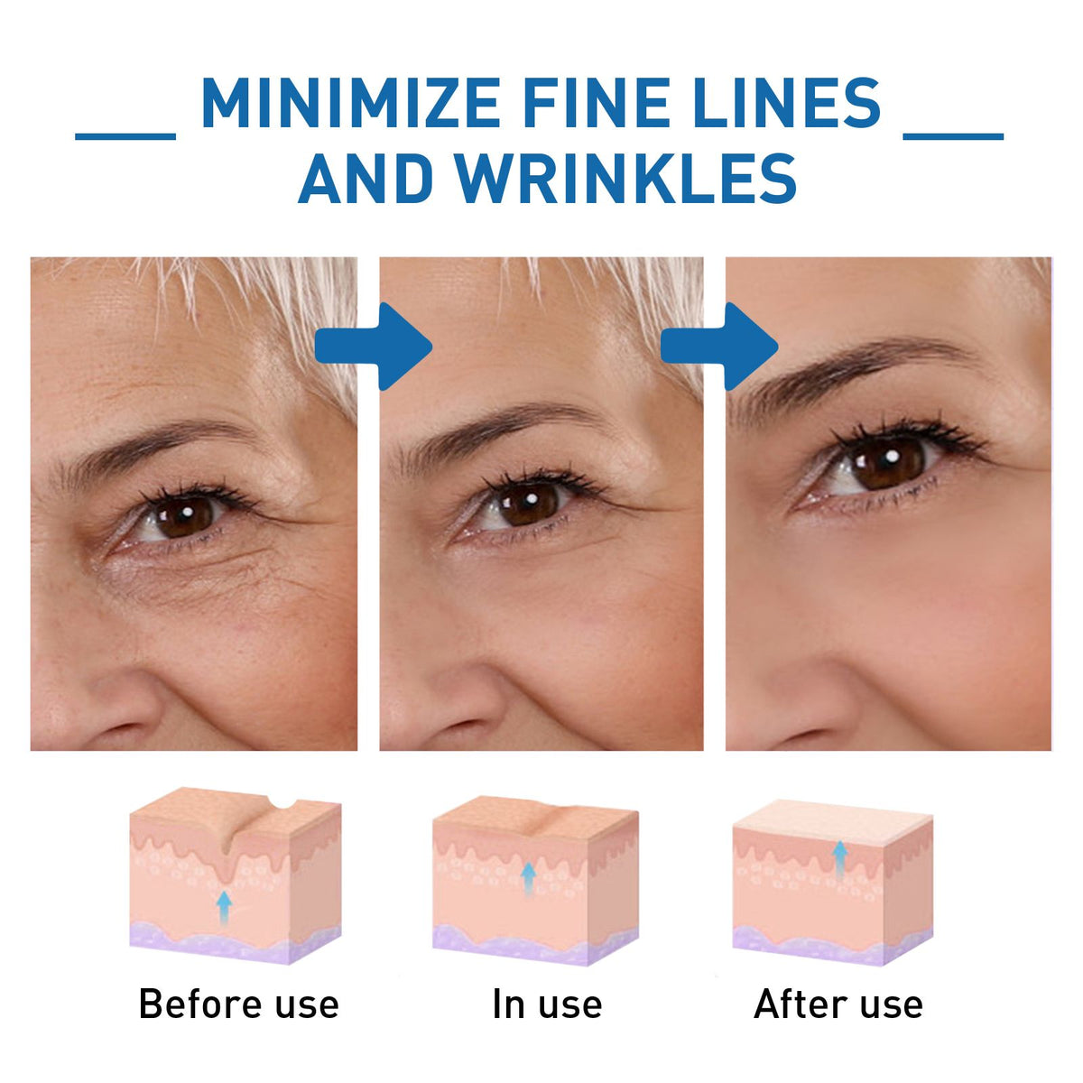 Before and after images of skin showing reduction in wrinkles, improved skin texture, and increased firmness after treatment