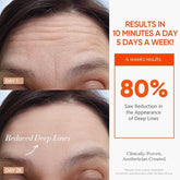 MLNshops LED Mask for Acne Treatment - Skin Care Solution