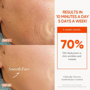 MLNshops LED Mask for Acne Treatment - Skin Care Solution