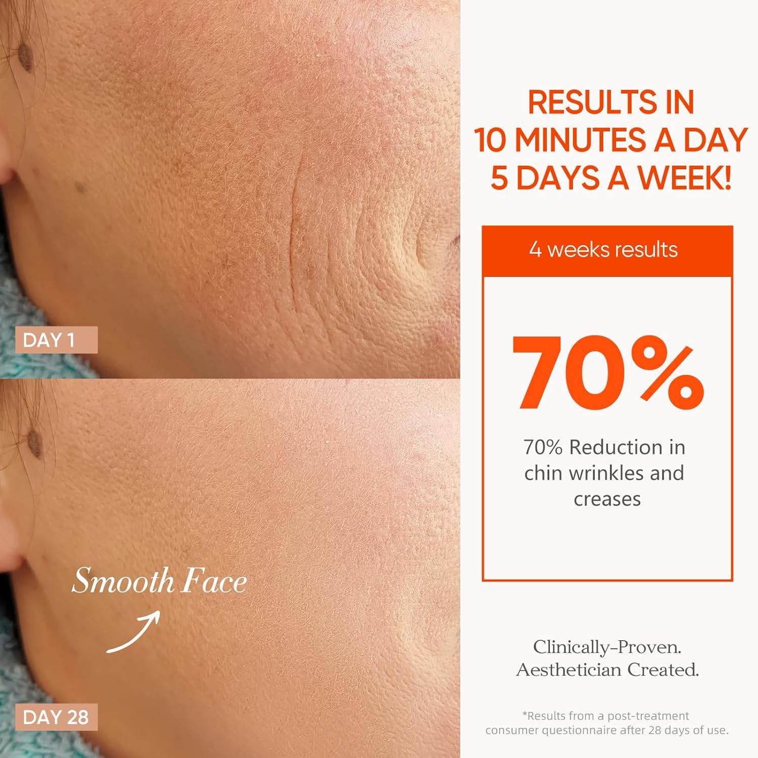 MLNshops LED Mask for Acne Treatment - Skin Care Solution